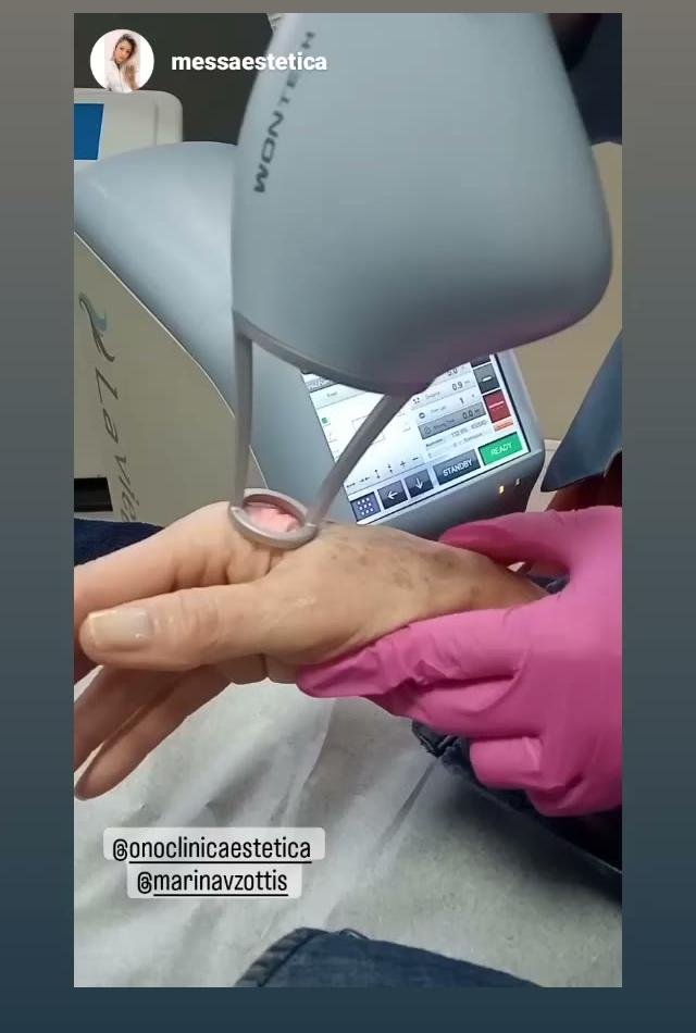 Laser Lavieen aplicado na região do colo e pescoço