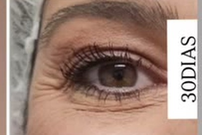 Depois — área dos olhos, 30 dias, com rótulo original da clínica