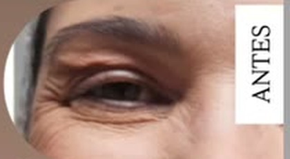 Antes — área dos olhos, com rótulo original da clínica
