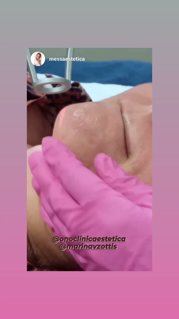 Procedimento de laser aplicado por Lú na Ono Clínica